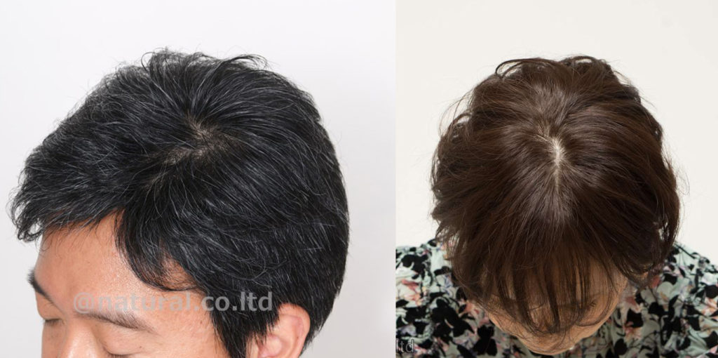 スキンフェイスの生え際写真